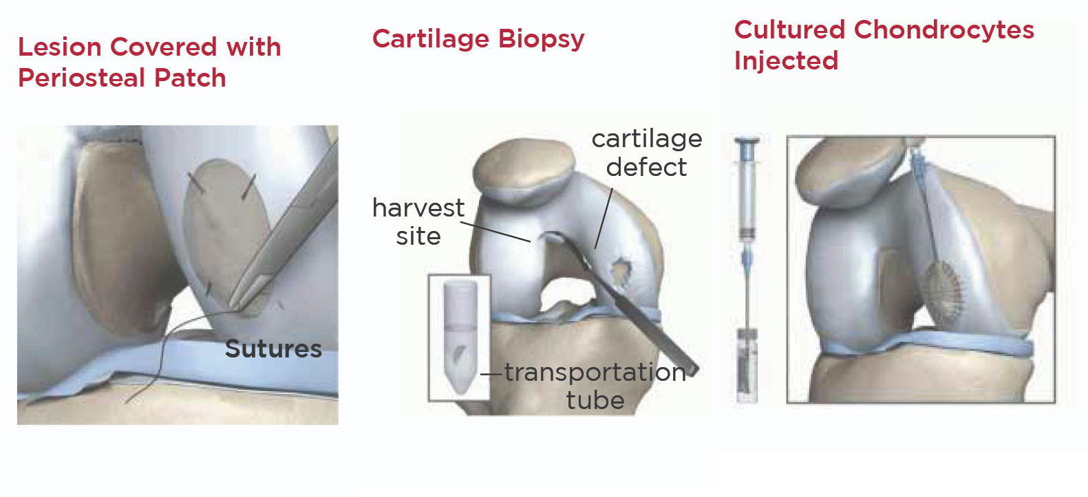 cartilage restoration