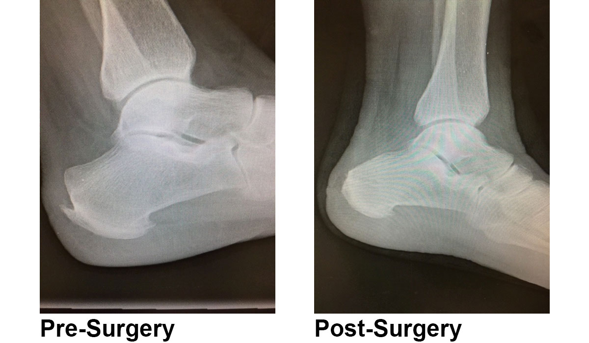 haglunds deformity surgery