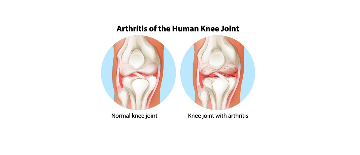 knee osteoarthritis