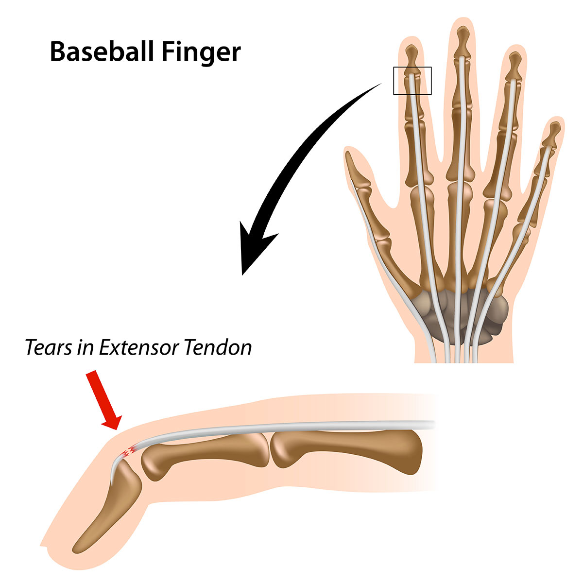 mallet finger
