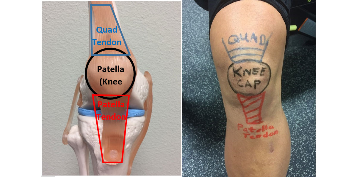 patella tendonitis