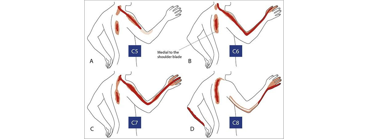 radiculopathy