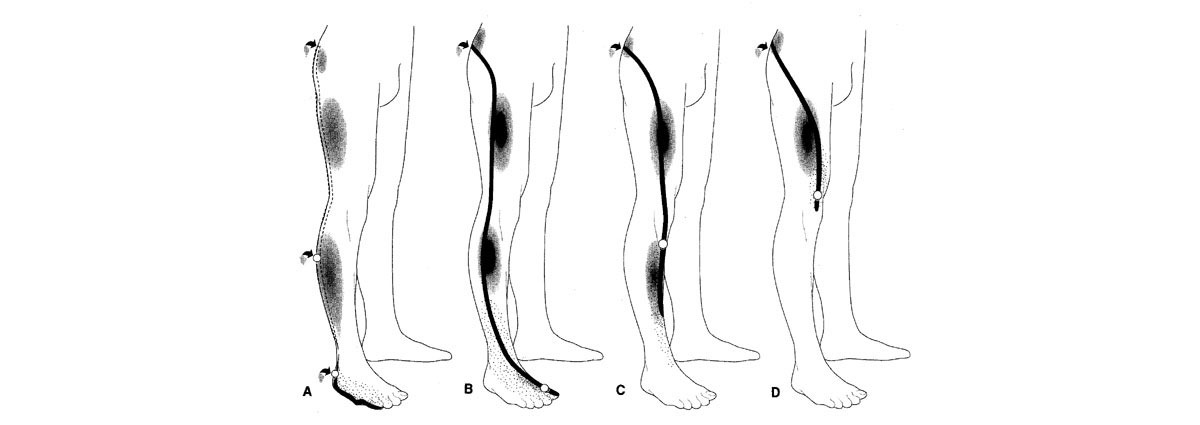 radiculopathy