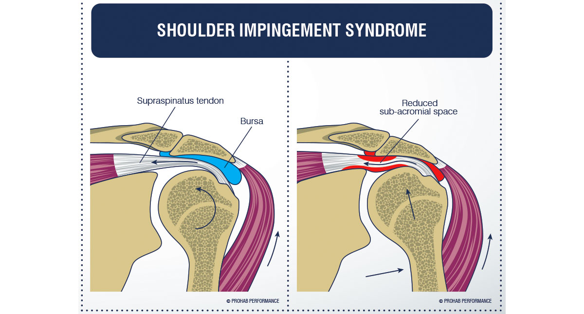 shoulder impingement