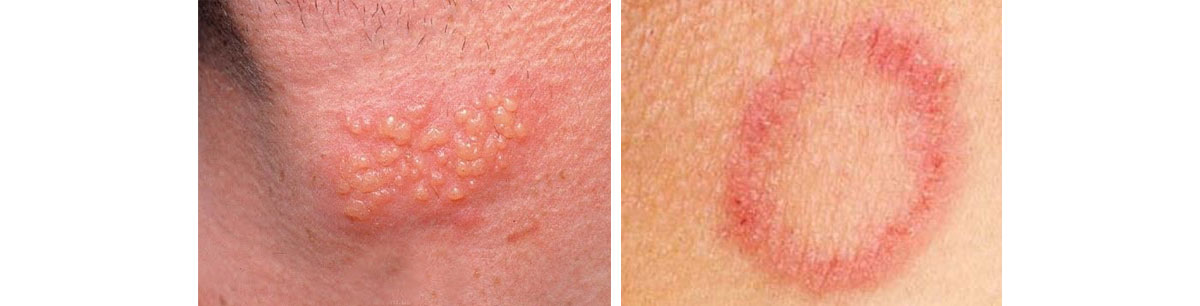 skin infections